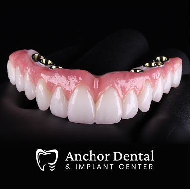 Hybrid Implant Bridge