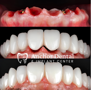 Porcelain Implant Bridge